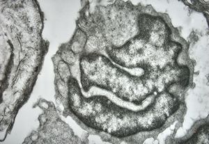 M, 70y. | mycosis fungoides - Sézary cell M, 70y. | mycosis fungoides - Sézary cell
